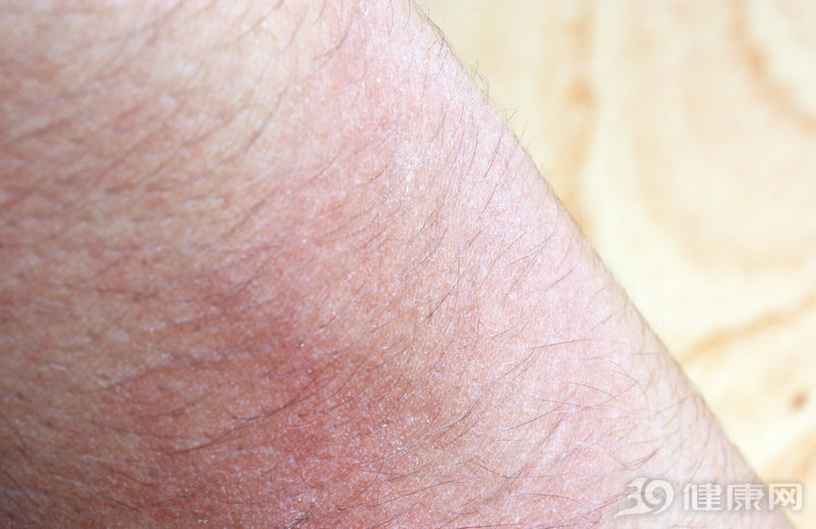 湿疹反复发作不好是什么原因,湿疹反反复复的一直不好怎么办