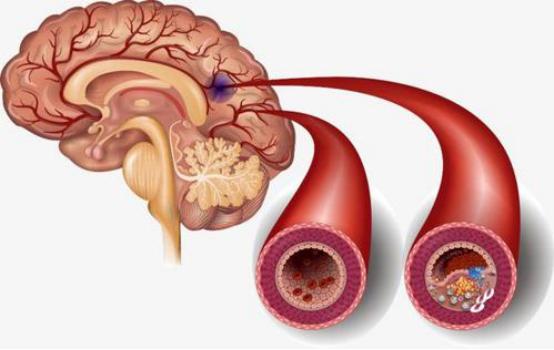 脑梗后遗症康复治疗的黄金时期,脑梗后遗症康复知识
