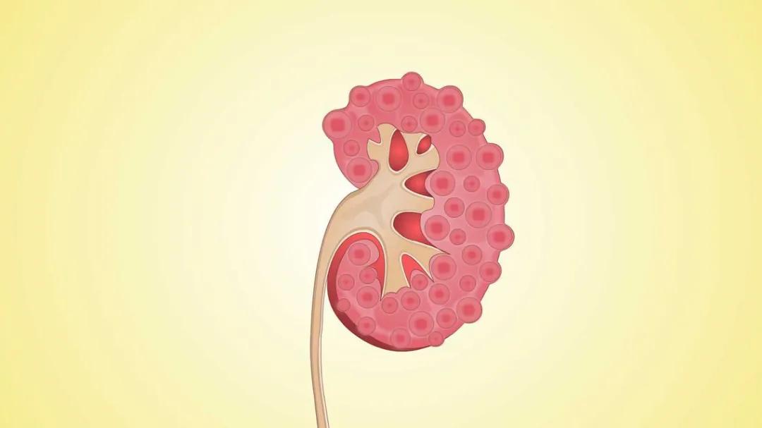 甲减和高血脂有关系,甲减高血脂症预防及治疗