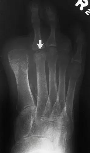 神经性骨关节病,神经性关节炎症状图片