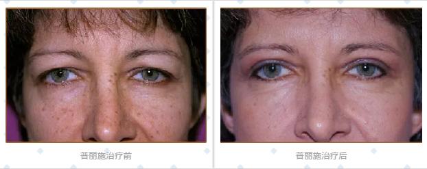 普丽普莱抗衰老,plexr电子医疗仪器