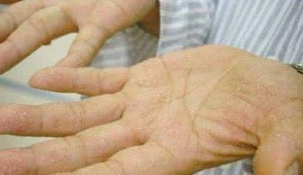 手脚长小水泡奇痒难忍教你一招,手脚起水泡奇痒无比什么办法最好