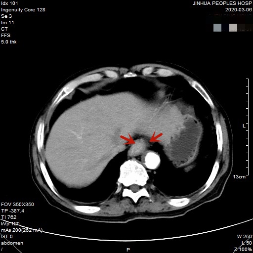贲门癌80岁手术好还是保守治疗好,医生建议80岁老人做贲门癌手术