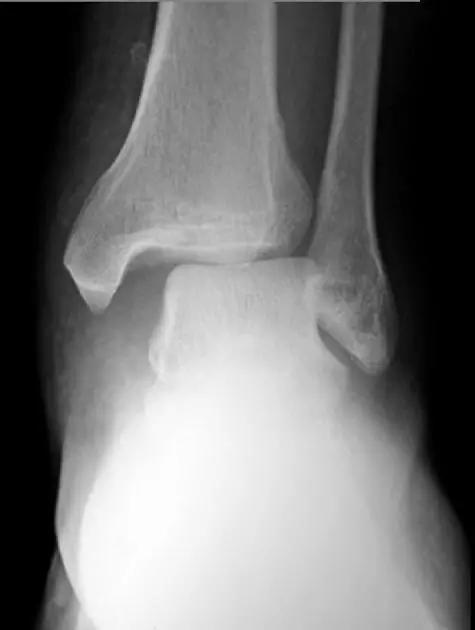 特殊骨折类型,特殊骨折体征