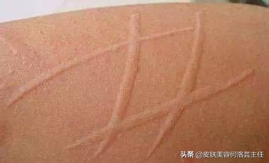 慢性荨麻疹治好了还需要忌口吗,麻疹怎么解释