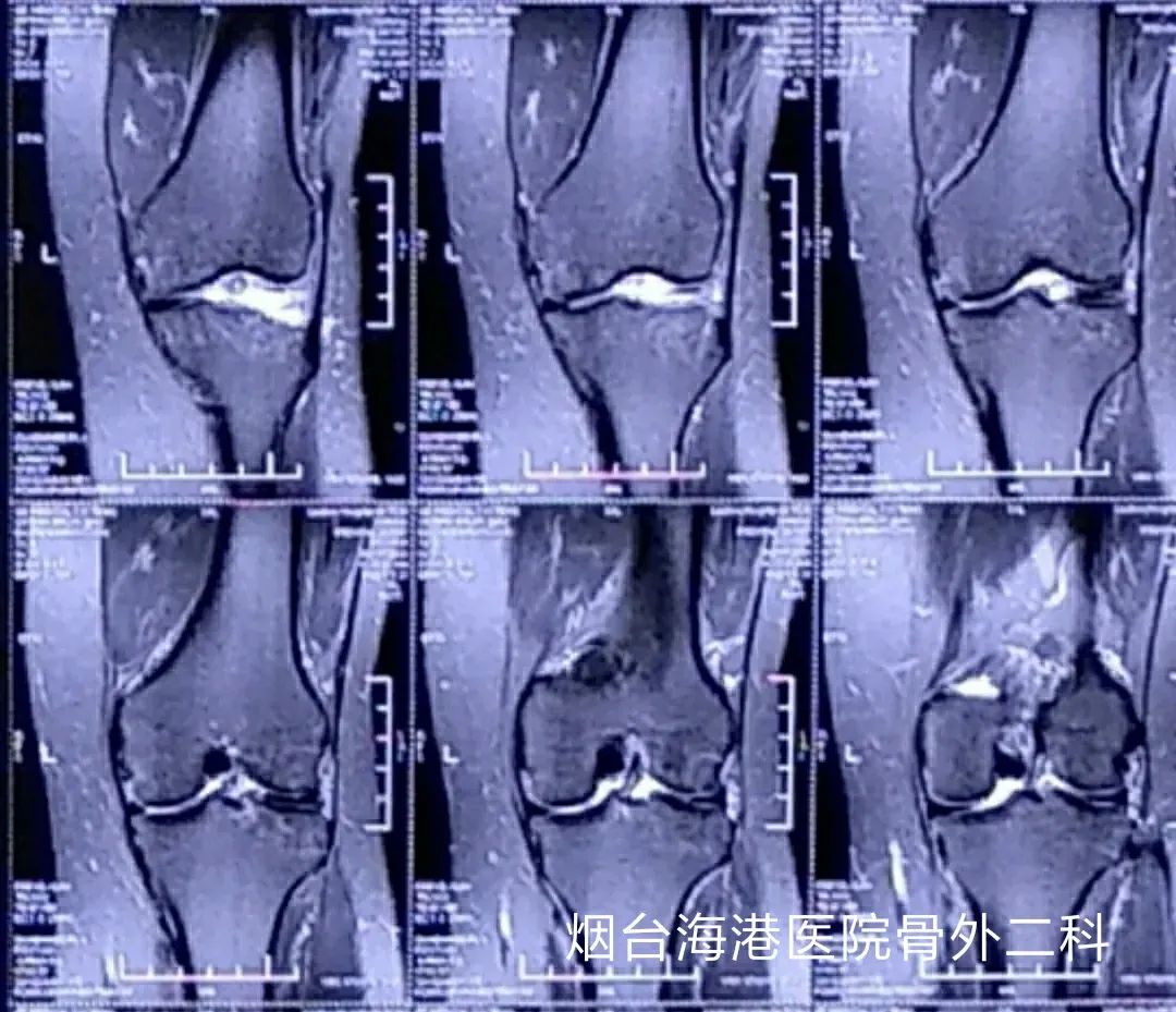 膝关节半月板损伤2-3度手术,半月板关节镜微创手术恢复状况