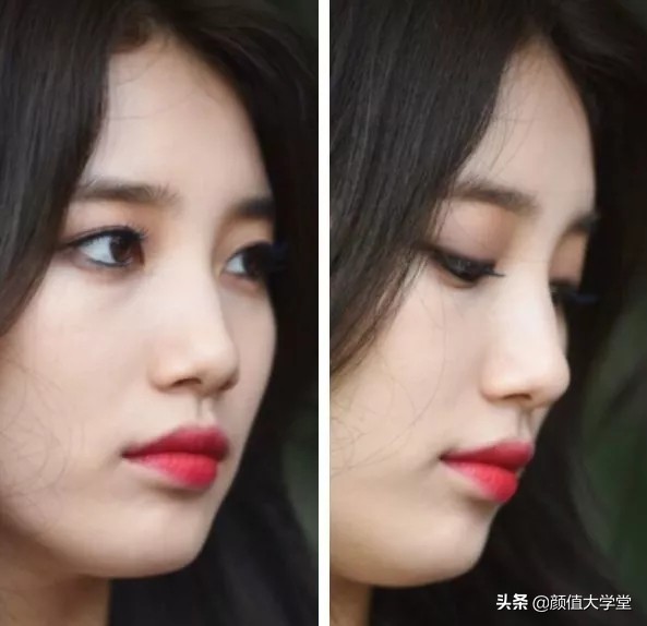 下巴后缩怎么拍侧颜,下巴后缩需要怎么矫正