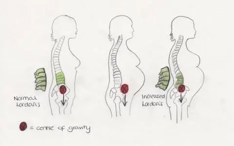 骶髂关节稳定性检查,怀孕后骶髂关节炎如何治疗