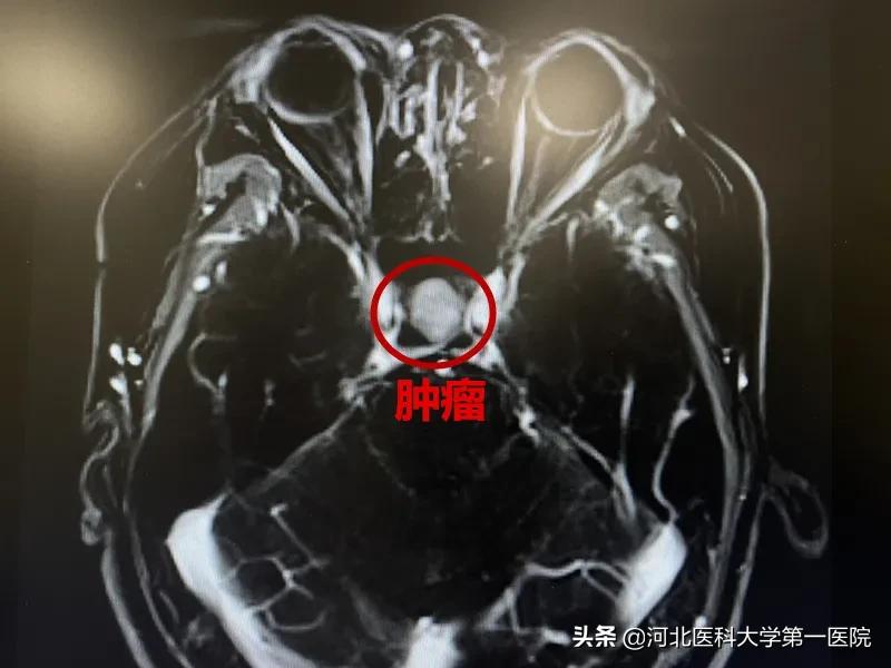 神奇魔法刀,一点就消!点亮肿瘤绝境患者,再生的希望之光