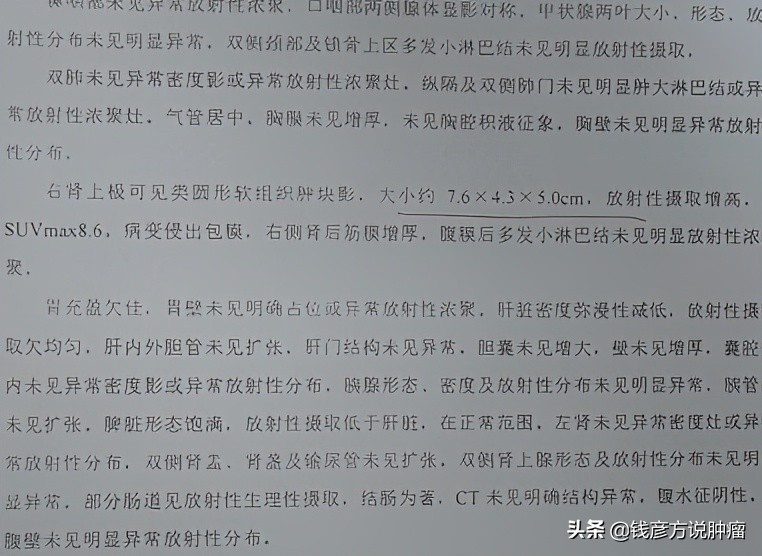 肾癌早期的6个防癌方法,肾癌中度