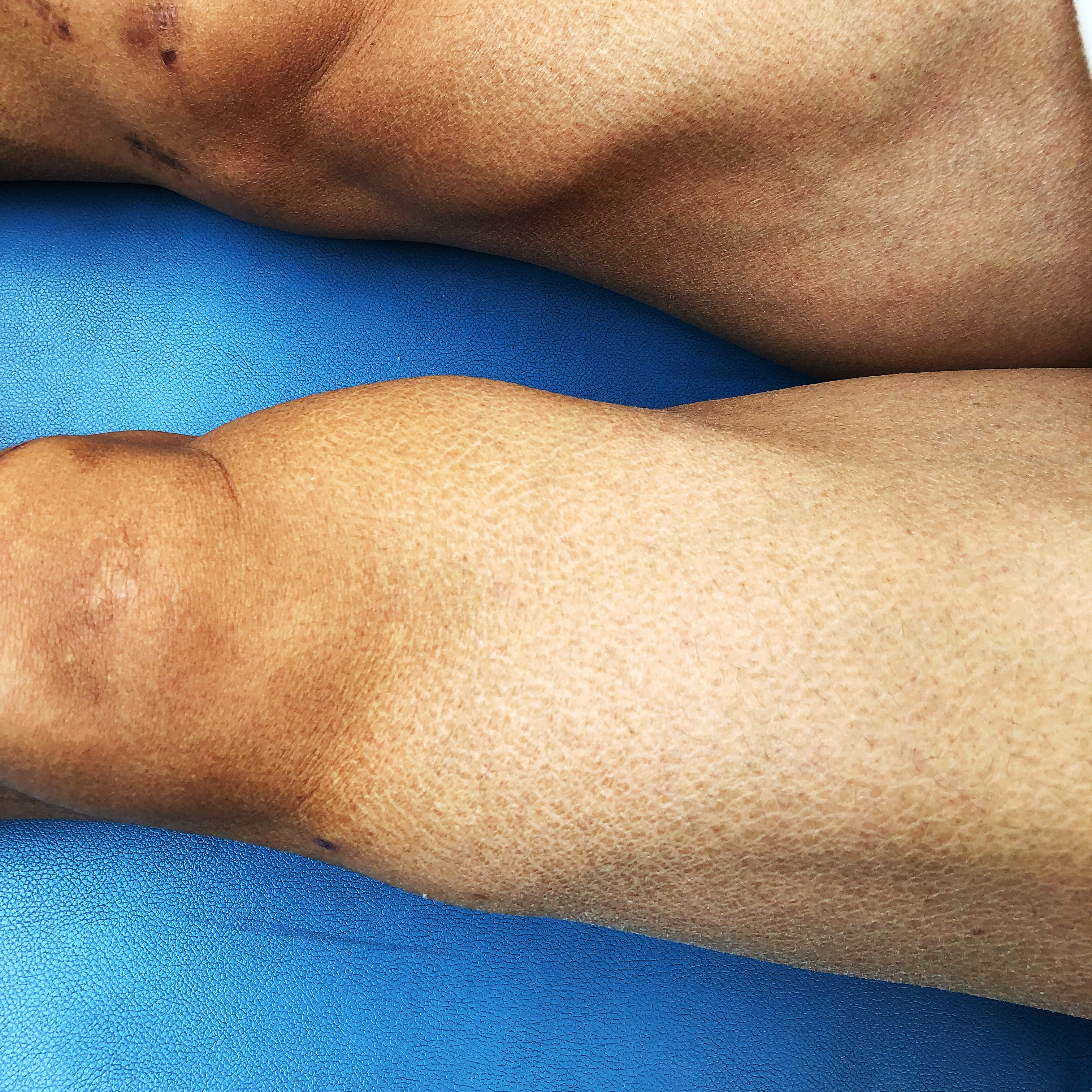 康复锻炼高抬腿正确做法,术后直抬腿的正确训练方法