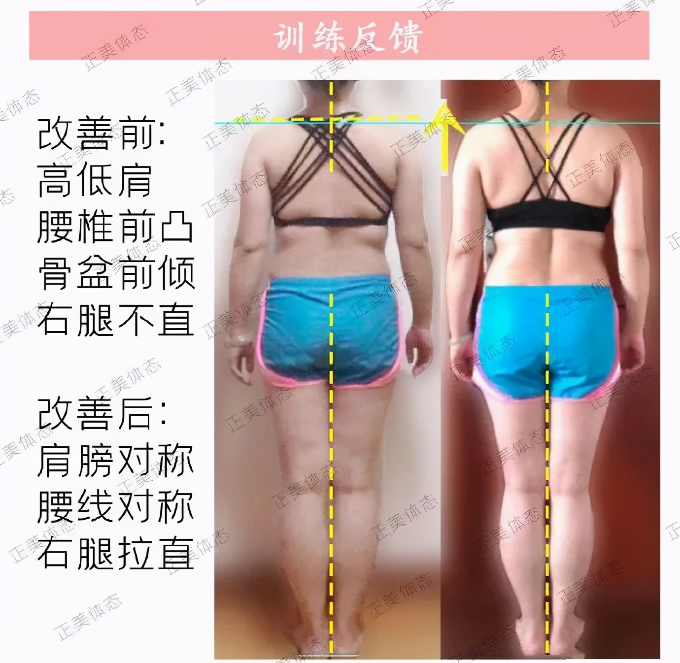 面部不对称程度怎么界定,高低肩会影响面部吗