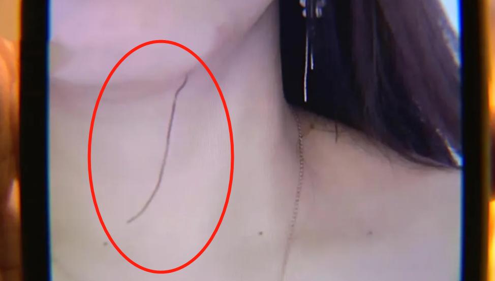 做了线雕线头出来了是正常现象吗,做完线雕半年针孔处出现异物