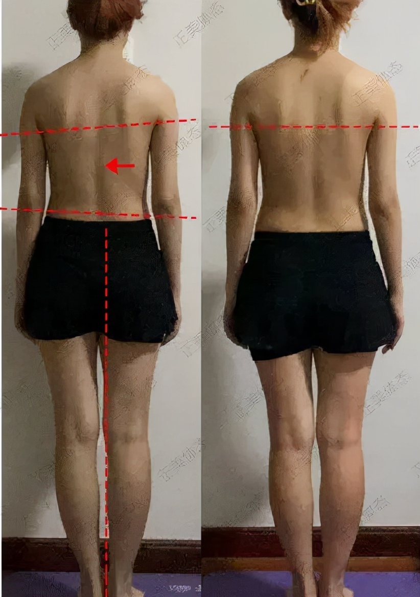 脊柱无侧弯但两侧腰线不对称,两边腰线弧度不一样是脊柱侧弯吗