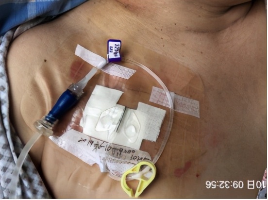 输液港皮肤过敏的处理,输液港输液有肿胀怎么处理