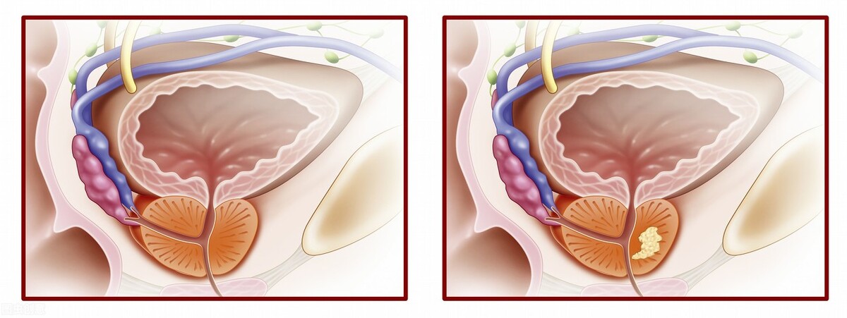 治疗慢性前列腺炎公认最好的药,男性慢性前列腺炎有什么表现