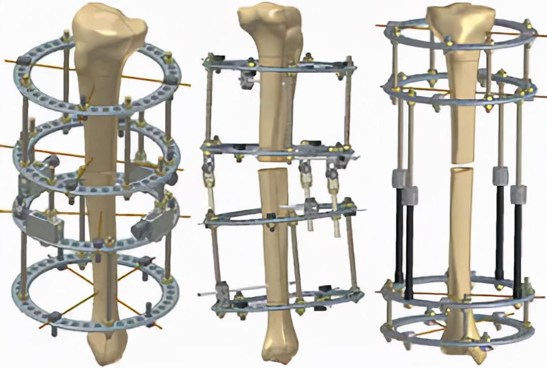 骨折后保守治疗需要注意什么,骨折手术有几种固定方法