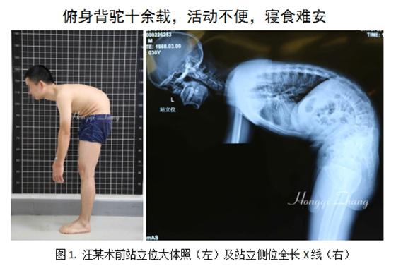 湘雅医院为重度强直性脊柱炎后凸畸形患者恢复“直立”人生