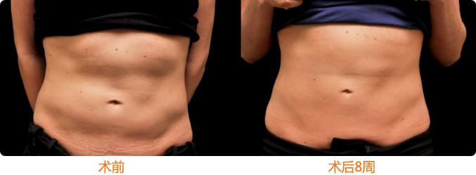 酷塑冷冻减脂可以减哪些地方,酷塑冷冻减肥效果