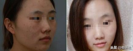 选择皮秒祛斑注意事项,选择光照美容仪的理由