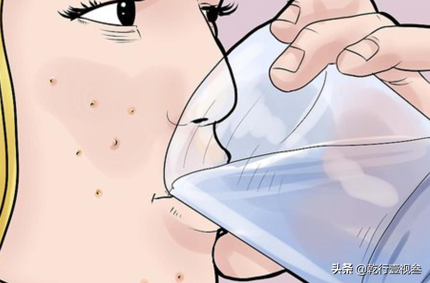 如何预防和祛除青春痘(上)