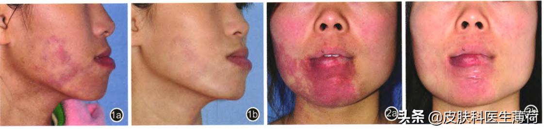 皮秒激光祛雀斑效果图,激光祛痘坑效果