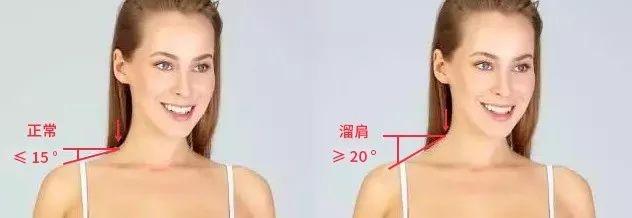 明星溜肩矫正前后,缩肩的危害