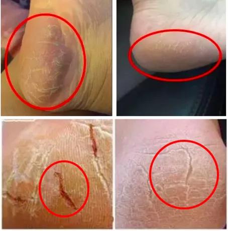 脚后跟老茧怎么去除,我的脚后跟有老茧变硬有细微开裂