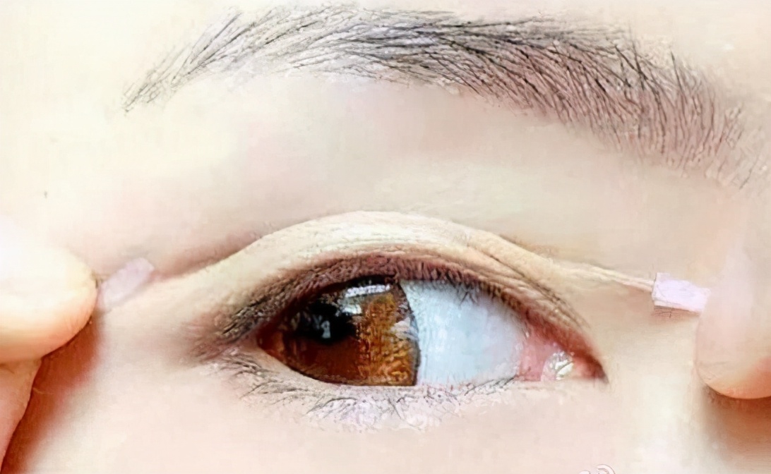 上眼皮松弛吃什么药,护肤上眼皮松弛直播