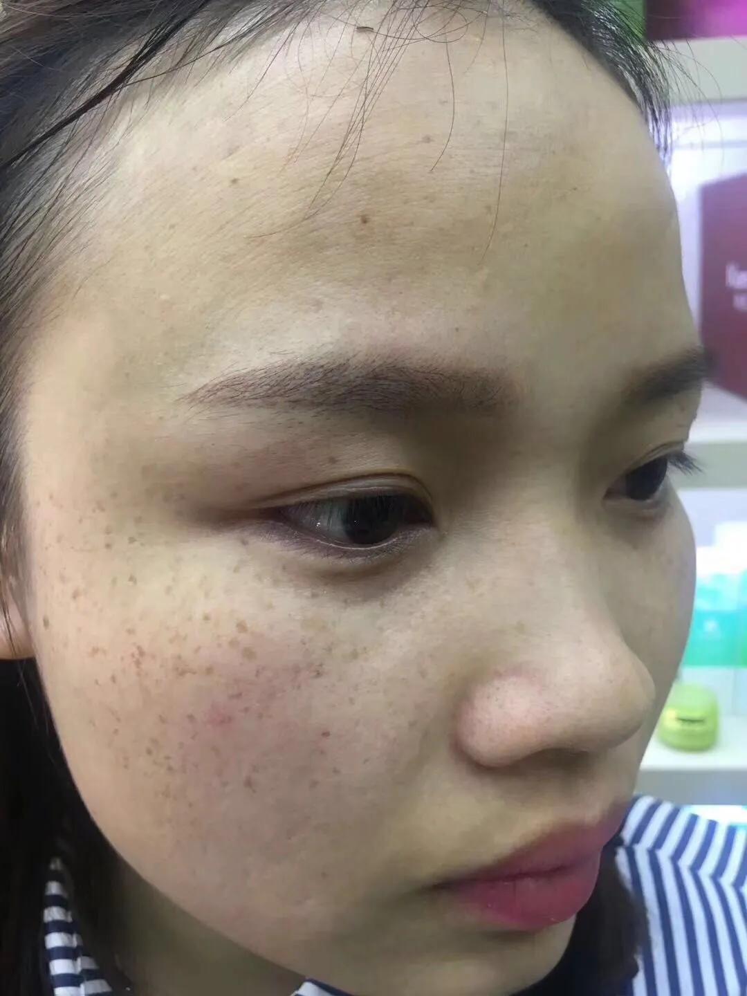 遗传性雀斑食疗方法,遗传性雀斑祛斑霜