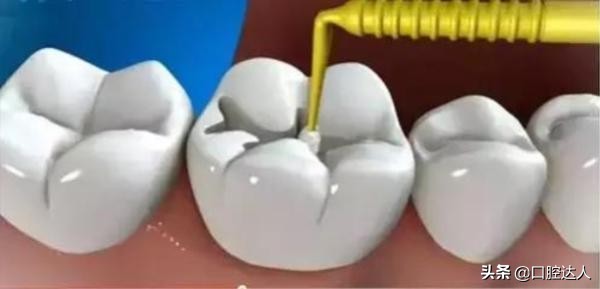 补牙后为什么会牙髓炎,补牙能治好牙痛吗