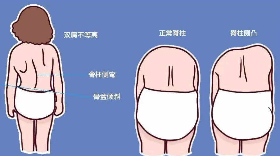 9岁小孩脊柱侧弯怎么补救,十岁孩子脊柱侧弯的照片