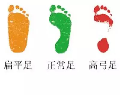扁平足不疼是后天还是先天,扁平足是脚趾没发力导致的吗