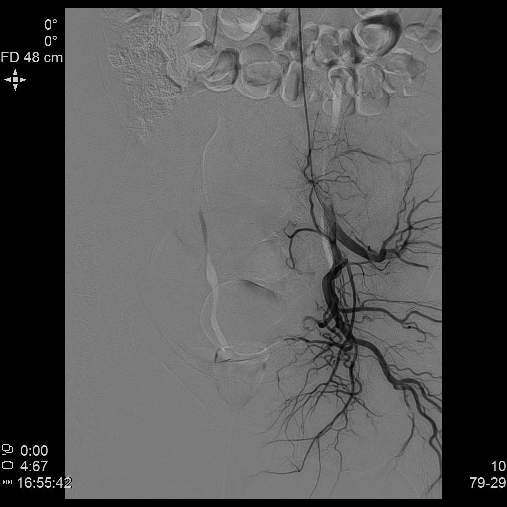 从手腕处做子宫动脉栓塞手术,子宫肌瘤做动脉穿刺有危险吗
