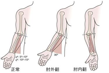 肘内翻矫正案例,肘内翻矫正会有后遗症吗