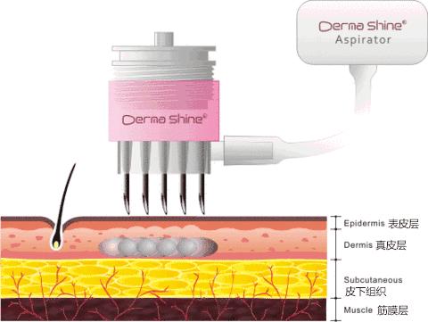 水光针是什么打了有什么作用,水光针如果停了会有什么影响