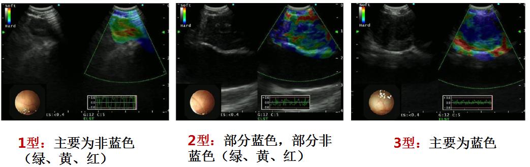 支气管镜高频电刀治疗中央型肺癌,支气管镜在早期肺癌诊断的意义