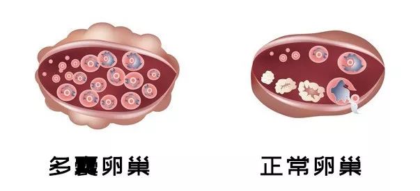 b超能查出卵巢多囊么,b超显示卵巢多囊改变怎么治愈