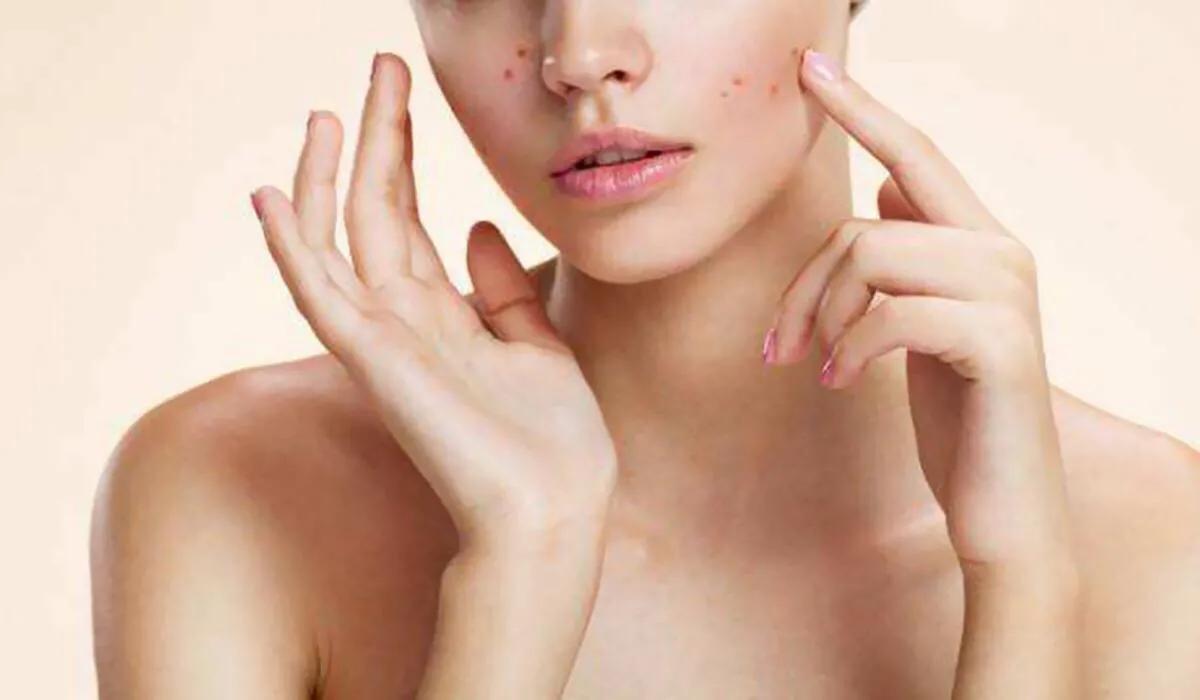 困扰多年的痘痘,豆豆的烦恼超详细攻略