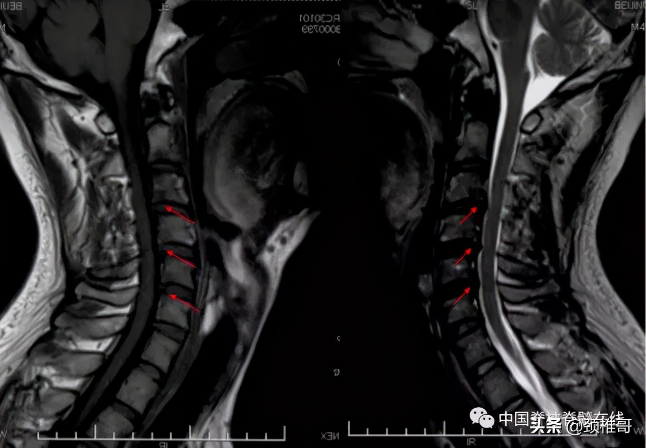 颈椎病的护理临床路径流程图,颈椎病的健康管理与康复指导