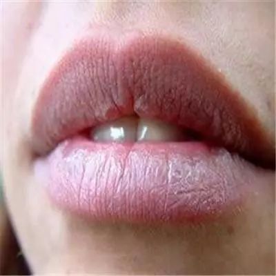 舔舔舔!唇炎找上门来怎么办?!