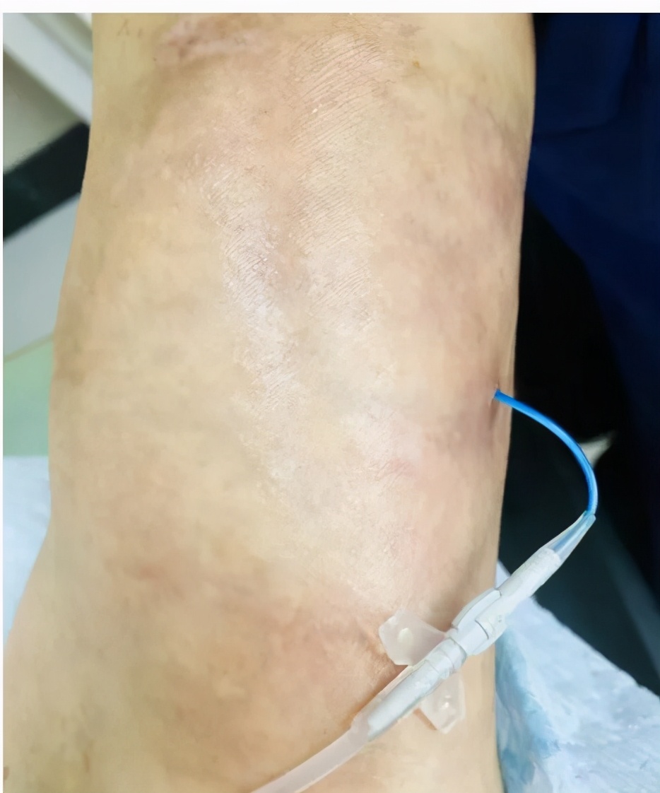 picc置管敷贴皮肤痒如何处理,picc置管防过敏贴膜进口