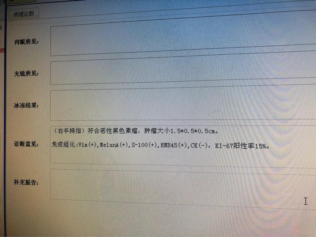手指甲黑线怎么看是不是黑色素瘤,指甲有甲母痣会癌变吗