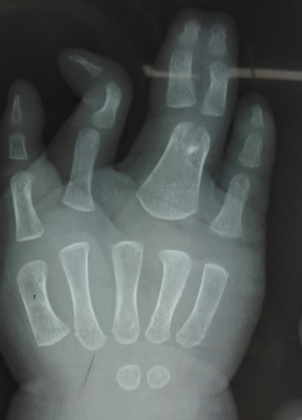 并指畸形免植皮案例,并指畸形