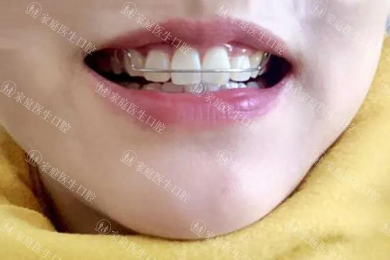 矫正牙齿的步骤及流程,矫正牙齿最快全过程