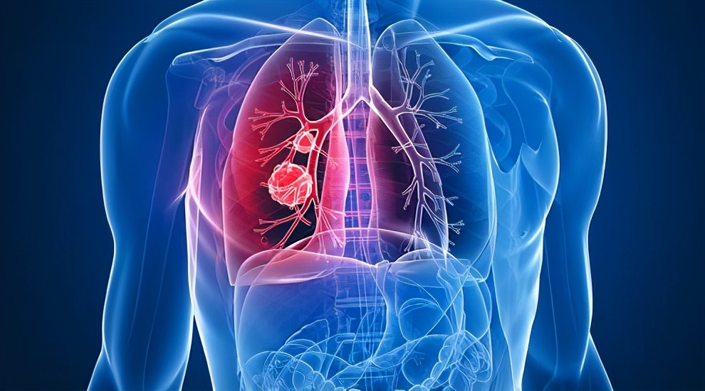 得了肺癌怎么办？肺癌康复谨记这3点，晚期也能带瘤生存