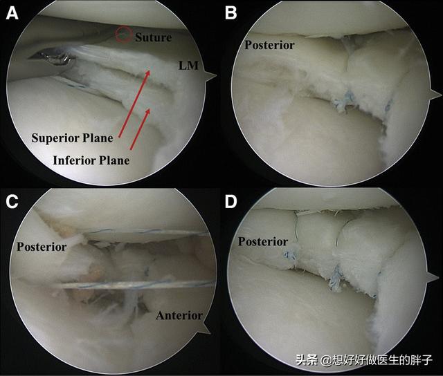 半月板撕裂手术后怎么自己做康复,半月板撕裂手术最佳自愈方法