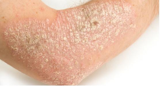 根治牛皮癣银屑病中成药,牛皮癣特效药罗氟司特