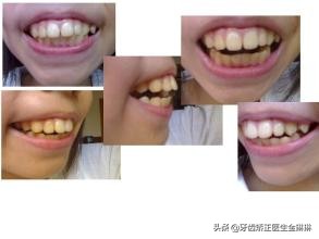 按压牙齿可以治龅牙吗,龅牙能用手摁回去吗