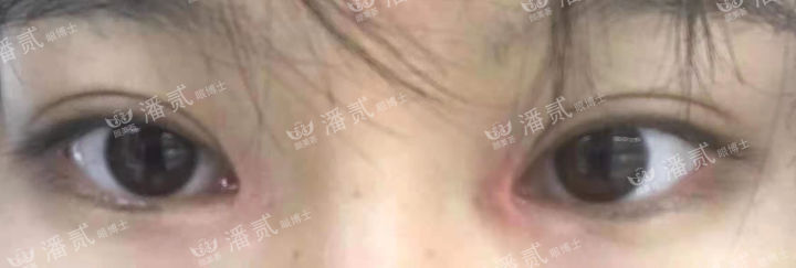 女孩眼部整形失败,内眼角整形失败
